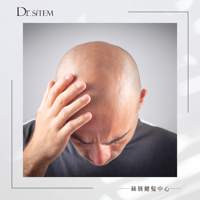 禿頭該如何預防?頭皮科教你該如何預防禿頭! 禿頭該如何預防?頭皮科教你該如何預防禿頭!